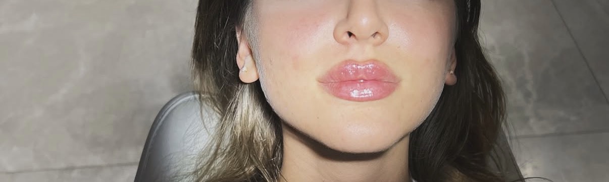 Botox & Filler